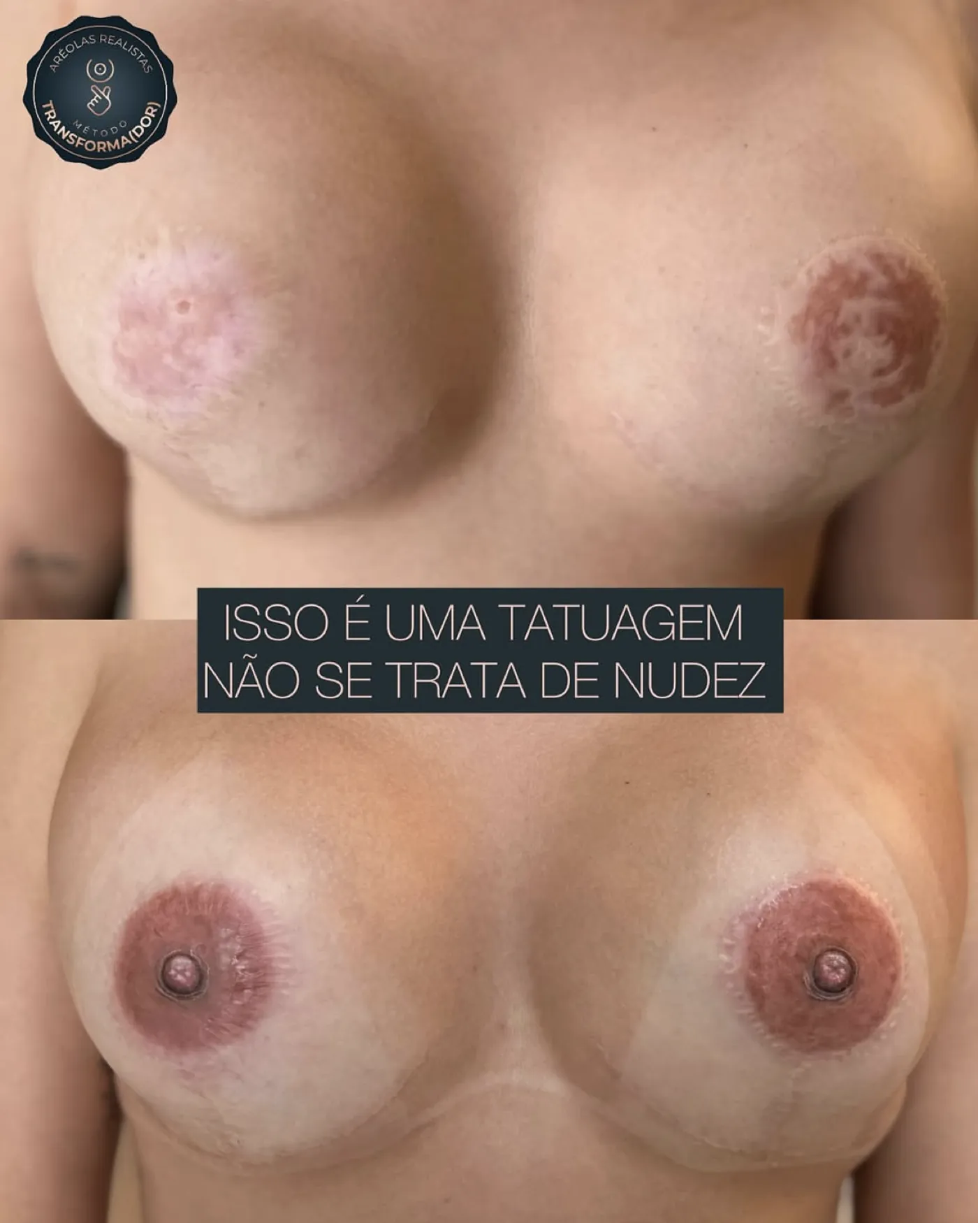 Registro clínico de reconstrução de aréolas por micropigmentação paramédica, antes e depois, em mamas reconstruídas