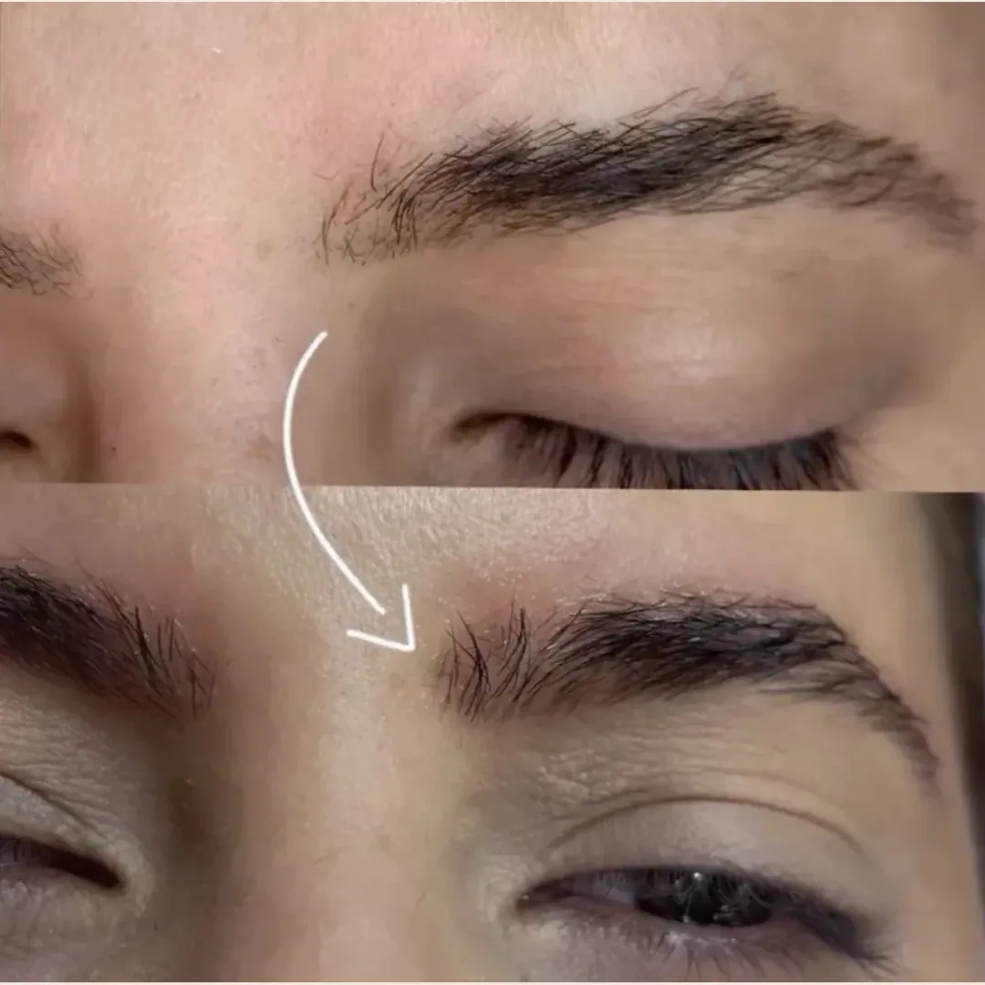 Sobrancelhas antes e depois de design estratégico, com indicação da correção de assimetria