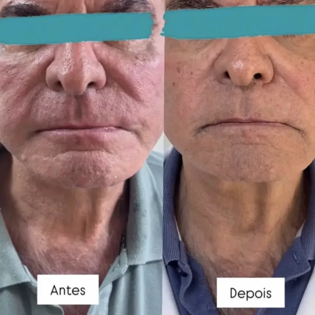 Comparação antes e depois de uma sessão de Ultraformer no rosto, em vista frontal