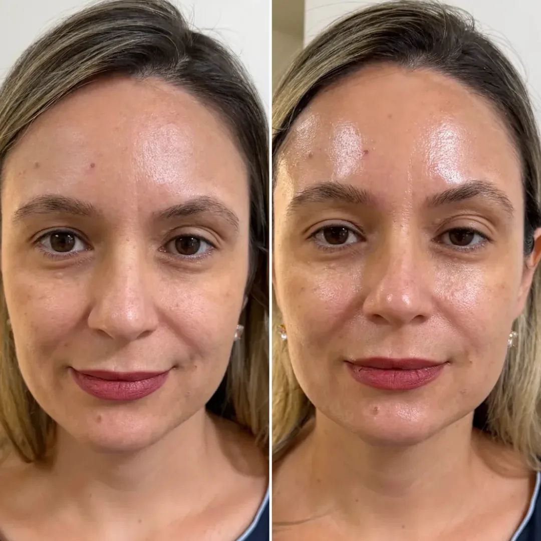 Rosto em vista frontal antes e depois de Ultraformer para firmeza facial