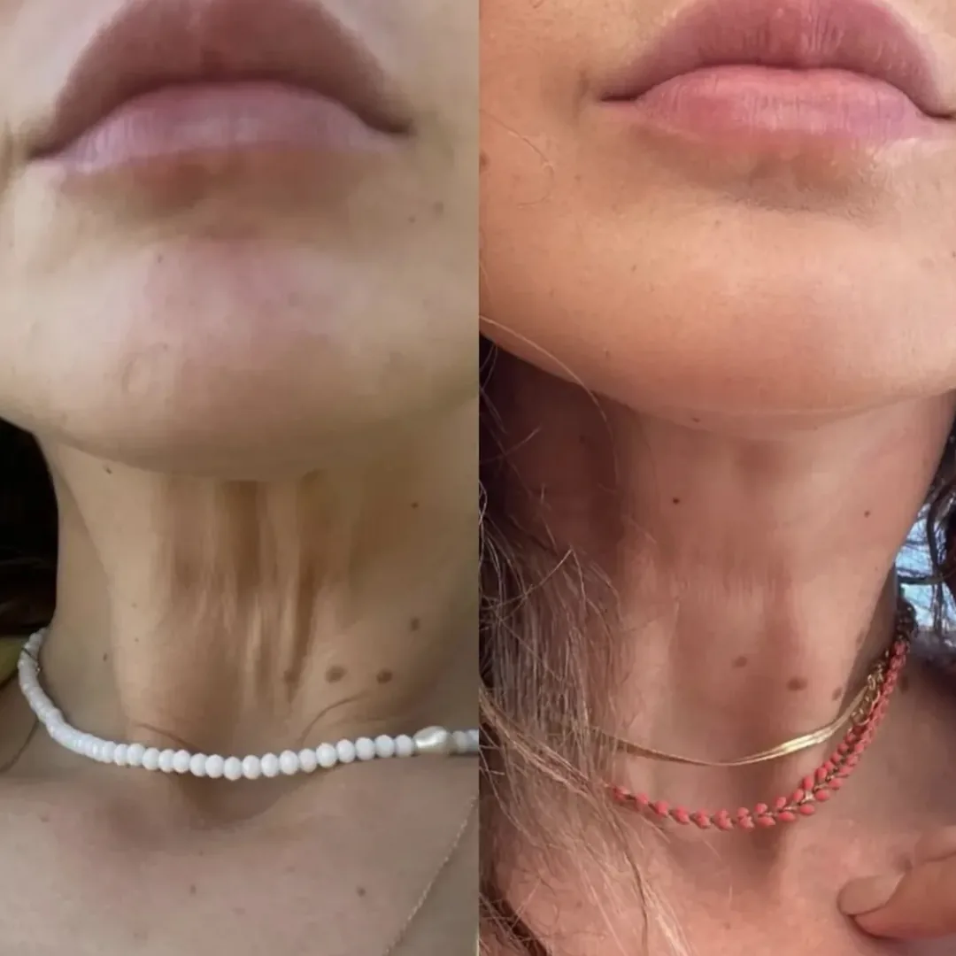 Pescoço antes e depois de Ultraformer, em vista frontal