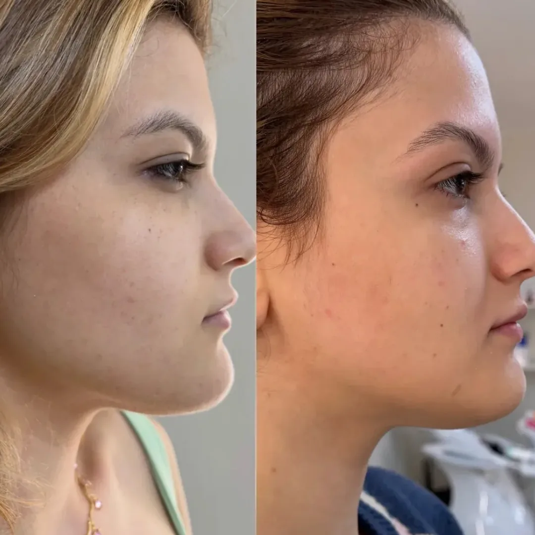Perfil do rosto antes e depois de Ultraformer no contorno mandibular